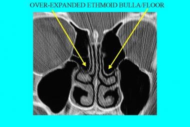 CT scan, nasal cavity. Overexpansion of the ethmoi
