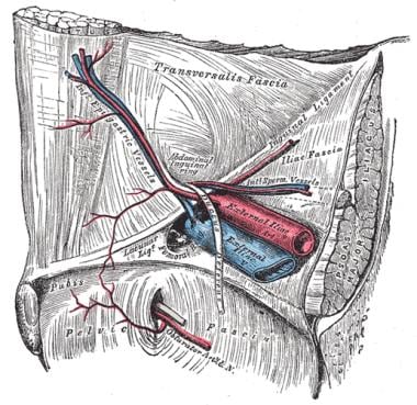 Retroperitoneal totally endoscopic prosthetic repair of lumbar hernia