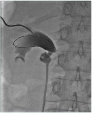 Occlusion balloon catheter used to help obtain ant