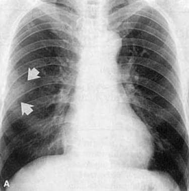 Initial chest radiograph of a 54-year-old man show