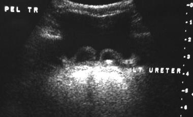 Bilateral ureteroceles with stones. This ultrasono