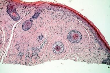 Histopathology of a fibrous papule shows focal fib