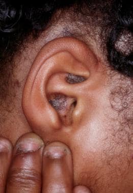 Lesions of discoid lupus erythematosus in the conc