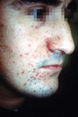 Lupus miliaris disseminatus faciei central facial 