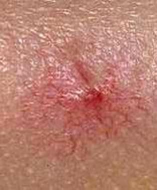 A spider nevus consists of a central arteriole wit