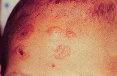 Target lesion of erythema multiforme. 