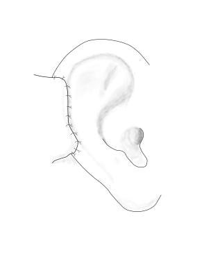 A postauricular flap is sutured in place. One or 2