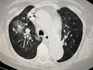 CT scan of an 82-year-old woman with proven SARS-c