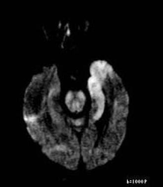 Axial diffusion-weighted image reveals restricted 