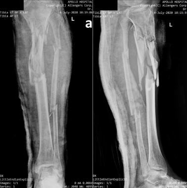Diaphyseal tibial fracture. Preoperative anteropos