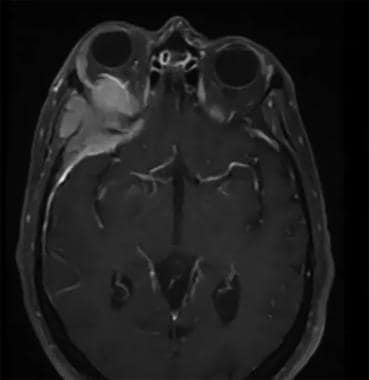 planum sphenoidale meningioma