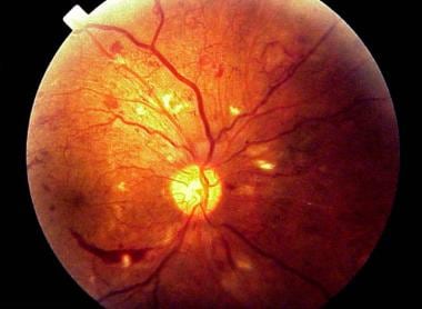 retinal flame hemorrhage