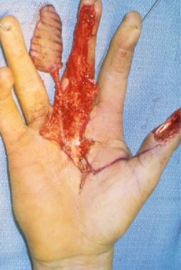 Intraoperative view of a Littler neurovascular isl