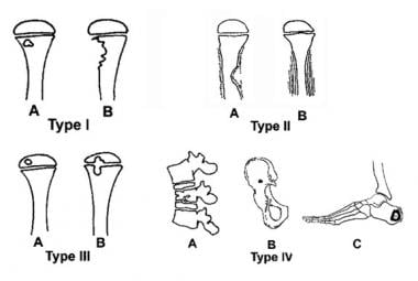 Modified classification of subacute osteomyelitis.
