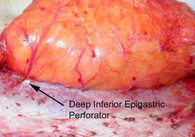 Perforating branches of deep inferior epigastric s
