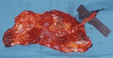 Clinical Case 4. Intraoperative picture. The right
