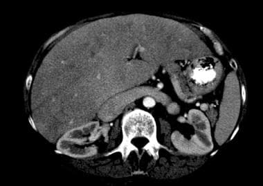 Cardiac cirrhosis and congestive hepatopathy. Cong