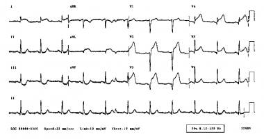 Myocardial Infarction Pathophysiology Flow Chart