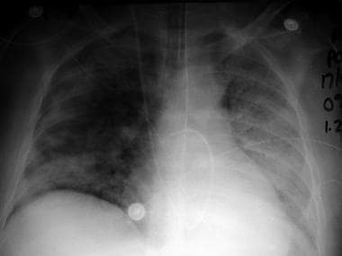 Acute respiratory distress syndrome (ARDS) shown i