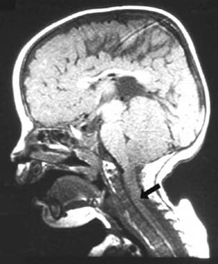Sagittal T1 MRI image of a child with a myelomenin