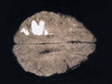 CT brain scan showing the appearance of a cerebral