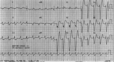 Hyperkalemia Flow Chart