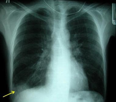A posteroanterior chest radiograph showing a perip