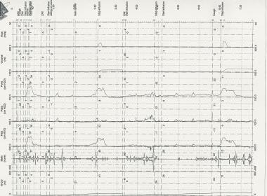 Bladder Diary Chart