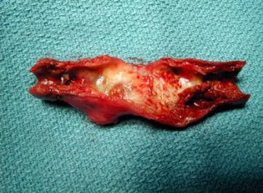Atherosclerotic plaque removed at time of carotid 