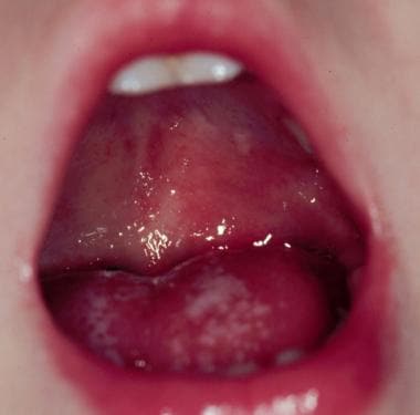 chemical burn mouth