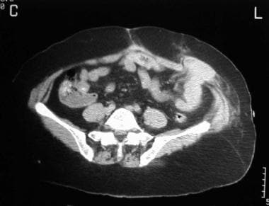 CT scan of a 64-year-old woman with vague abdomina
