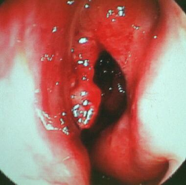 Typical view of a middle meatus in a patient with 