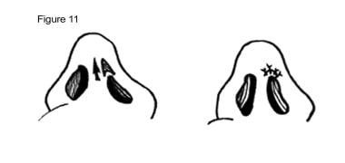 Cleft lip nasal deformity. Elevation of nostril ap