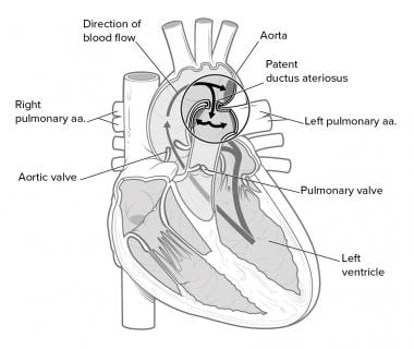 Patent Ductus Arteriosus (PDA): Background, Anatomy, Pathophysiology