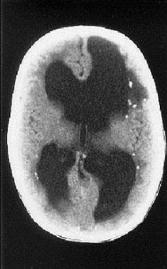 Cranial CT scan of infant born with symptomatic co