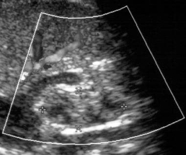 Renal sonogram of a newborn with spontaneous pneum