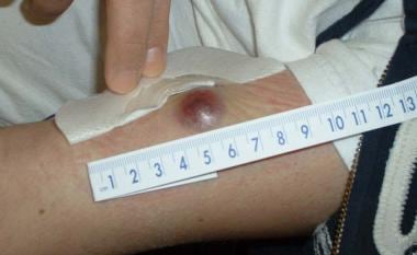 Leukemia cutis (a skin nodule) in a patient with l