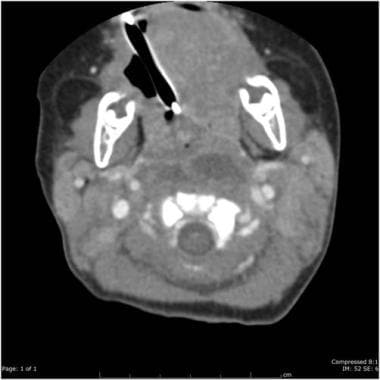 retropharyngeal abscess mri