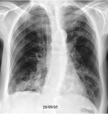 A case of evolving aspiration pneumonia (1 of 4 im