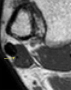 Turbo spin-echo (TSE) T1-weighted MRI shows hypoin