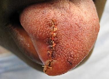 Surgical site sutured.