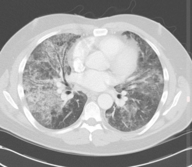 hiv感染伴PJP患者胸部CT表现为ea