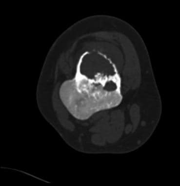 CT axial section of same lesion as in image above.