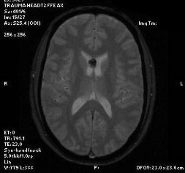 Axial GRE image at the level of the lateral ventri