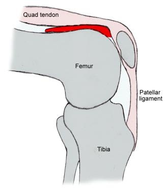 Illustration of knee joint. Note suprapatellar rec