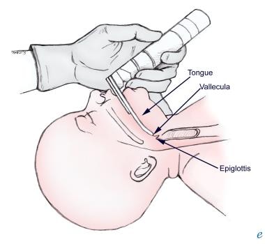 Laryngoscope blade tip in vallecula. 