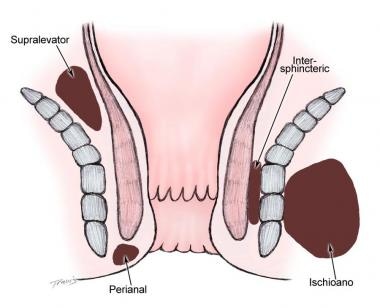 anal fistulotomy post Deep