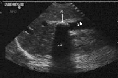 Longitudinal view of the gallbladder (gb) revealin