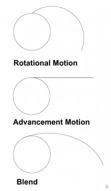 Movement of the flap into adjacent tissue. 