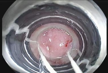 Endoscopic mucosal resection (EMR). Aspiration of 